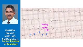 Findings and conclusion for this ECG [upl. by Flodur]