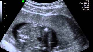 amnioinfusion 18 wks anhydramnios GENESYS FERTILITY CENTER [upl. by Saffier33]