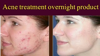 how to get rid of acne overnight  two acne treatment product review 100 result [upl. by Strephon]