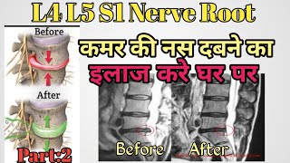 L4 L5 S1 nerve root compression exercises  buldging Disc exercises  Herniated Exercise  in hindi [upl. by Helgeson]