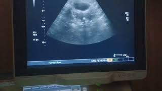 Osseous metaplasia uterus pelvicultrasound pathology [upl. by Akirdnahs]