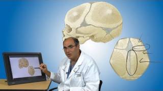 Craniosynostosis and its treatment  Boston Children’s Hospital [upl. by Acsicnarf]