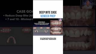 Deep Bite Case Veneer Prep [upl. by Toms]