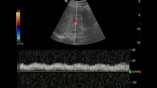 Portal Vein Doppler  Normal Monophasic Flow [upl. by Reseta]