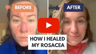 How I Healed My Rosacea The Solution Dermatologists Dont Want You to Know About [upl. by Ellehsim]