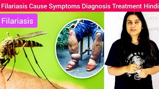 Filariasis Cause Symptoms Diagnosis Treatment in Hindi  Filariasis Cause by  What is Filariasis [upl. by Halley]