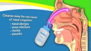 Nasal Irrigation to Treat Sinusitis Common Cold Allergy Better Than Neti Pots [upl. by Kenzi46]