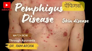 Pemphigus  पेम्फीगस  Skin disease  Treatment Through Ayurveda  Dr Ram Arora [upl. by Eednus]