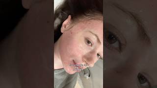 Trying Potenza treatment ❤️‍🩹 skincare potenza microneedling [upl. by Fortunia905]