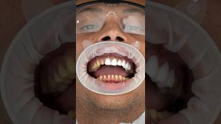 Veneers can change your smile forever dentist shorts zirconiacrown [upl. by Kelwin]