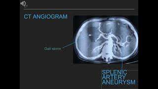 Splenic artery pseudoaneurysm embolization with nBCA glue [upl. by Ladew]