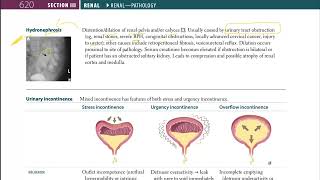 35 Hydronephrosis [upl. by Egroej]