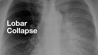 Lobar Collapse examples of each lobe [upl. by Jd662]