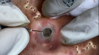 Big Cystic Acne Blackheads Extraction Blackheads amp Milia Whiteheads Removal Pimple Popping 094 [upl. by Niuqauj124]