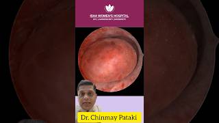 Endometrial Polyp surgery  DrChinmay Pataki  Isha Women’s Hospital  polypterus [upl. by Volin]