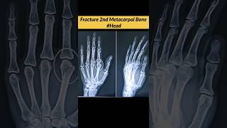 FRACTURE 2nd Metacarpal Bone oF Hand radiographerusn radiography radiographer xray [upl. by Ron]