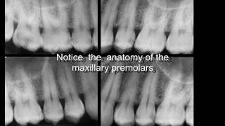 Three rooted maxillary premolars [upl. by Gustafson]