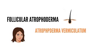 FOLLICULAR ATROPHODERMA ATROPHODERMA VERMICULATUM KERATOSIS PILARIS ATROPHICANS DERMATOLOGY [upl. by Uoliram948]