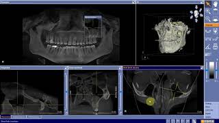 CBCT Coronal Plane 1 [upl. by Bartko]