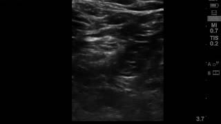 Ultrasound guided popliteal sciatic nerve block [upl. by Reel]