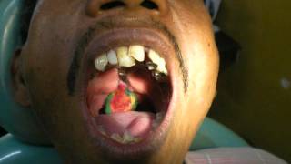 Dr Pankaj Kharade Pharyngeal obturator impression [upl. by Aney15]