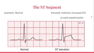 Basic EKG Interpretation for Nursing Students [upl. by Aicatsana878]