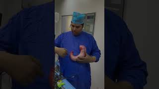 What is removed in sleeve Gastrectomy drrksingh bariatric definitecure obesity [upl. by Dowd760]