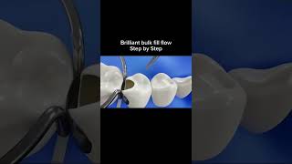 Laser filling  composite filling  tooth repair dentalcaries dentist dentalfilling [upl. by Arikahs100]