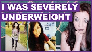 I Was Severely Underweight  Called Anorexic [upl. by Rickie]