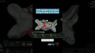 AFib Ablation Procedure Using 3D Map of Heart [upl. by Noswal]