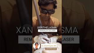 Xanthelasma Removal by CO2 Laser  Fat deposit removal treatment xanthelasma shortvideo skincare [upl. by Enom]