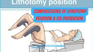 complications of lithotomy position amp its prevention obgyneLearning [upl. by O'Hara]