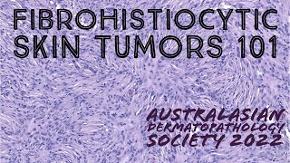 Fibrohistiocytic Skin Tumors 101 Australasian Dermatopathology Society 2022 meeting pathology [upl. by Wojcik]