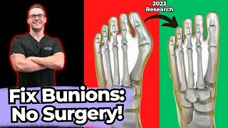 TOP 13 Ways to Shrink Bunions Naturally 1 HUGE SECRET [upl. by Gelb]