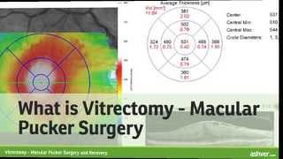 Vitrectomy  Macular Pucker Surgery and Recovery [upl. by Midis]