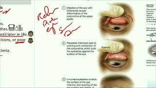 Ophthalmology Trachoma شرح بالعربى الرمد الحُبيبي التراخوما [upl. by Demetris]