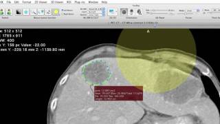 ROI Segmentation with aycan workstation former OsiriX PRO [upl. by Bertilla338]