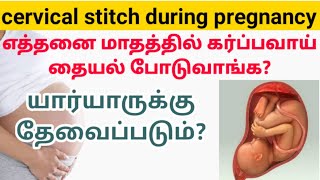 cervix stitches during pregnancy in tamil  cervical stitch in pregnancy tamil  cervical cerclage [upl. by Erbua123]