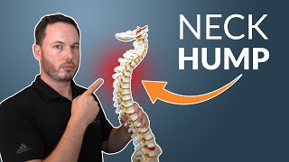 How To Correct Your NECK HUMP  Simple Stretch amp Exercise [upl. by Tryck598]