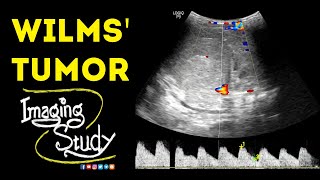 Wilms Tumor  Ultrasound  Case 47 [upl. by Anaiq850]