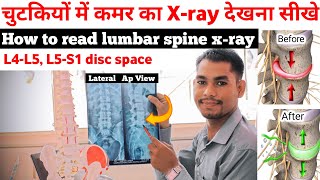 how to read lower back x rays l4 l5 s1 lumbosacral X Ray reading Lumbar spine xray complete study [upl. by Leitnahs]