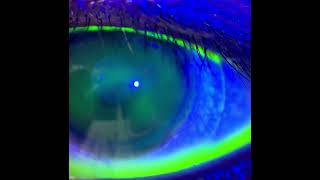 Conjunctive Staining After Scleral Lens Removal [upl. by Allix669]