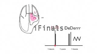 Mitral stenosis murmur [upl. by Acireed]