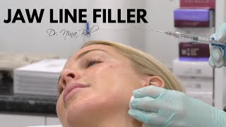 Jawline Filler Before and After 💕Jawline Transformation with Dr Nina Bal 💕 Jawline Filler Experience [upl. by Clintock]