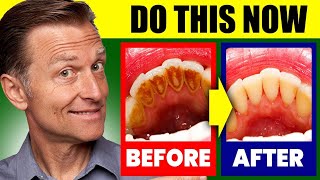 Natural Solution for Plaque Cavities and Gingivitis [upl. by Styles]