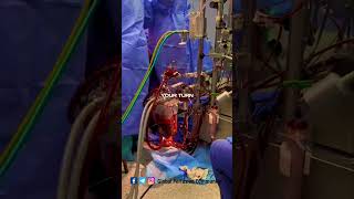 Perfusion aspects by a clinical Perfusionist perfusion nurse [upl. by Gelasius759]