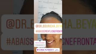 Greffe de Cheveux femme  Dr Bouricha Beya [upl. by English]