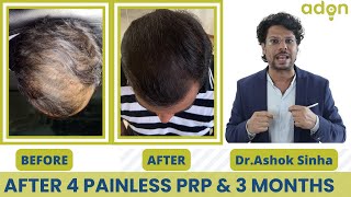 Activated PRP Hair Treatment amp Result [upl. by Ahsiemal]