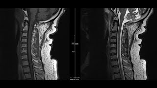 Noncontrast MRI cervical spine search pattern [upl. by Nirro]