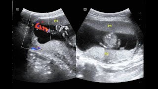 usg velamentous cord insertion in twin pregnancy [upl. by Annav]